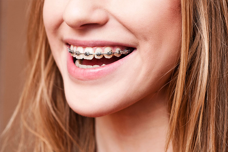 Invisalign Austin Tx